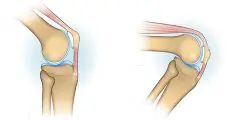 اسباب امراض الركبة وطرق علاجها ونصائح مهمة