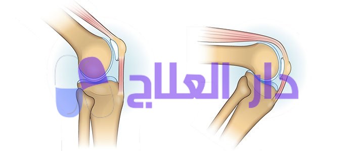 اسباب امراض الركبة وطرق علاجها ونصائح مهمة