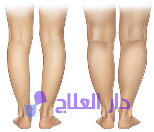 علاج تقوس الساقين مع دكتور عمرو أمل