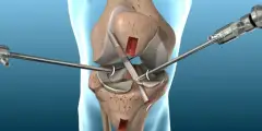 دليلك لاختيار احسن دكتور ركبة فى مصر​